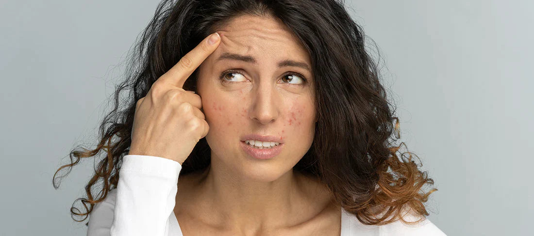 The Connection Between Stress and Acne: How to Break the Cycle