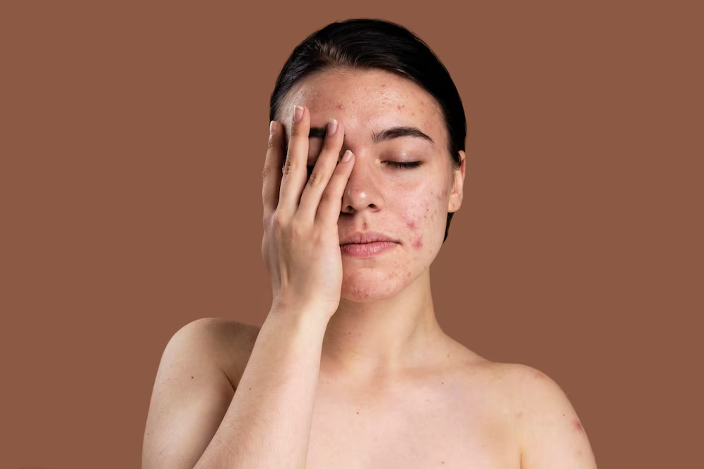 Can Toothpaste Help Pimples? (Myth Busted!)