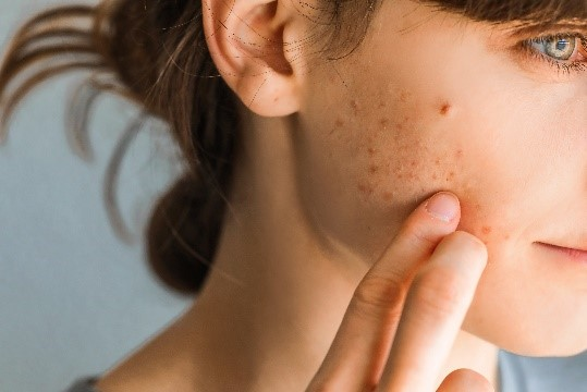 How Long Does Teenage Acne Last?