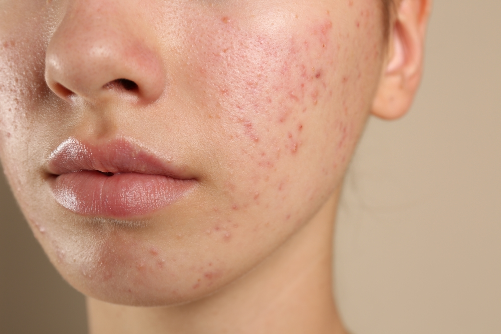 Can Your Diet Really Cause Acne? Debunking Myths for Teens