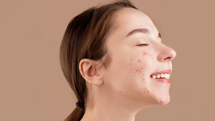 Can Toner Help with Teenage Acne? A Guide for Teens and Parents